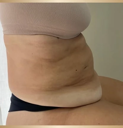 Criomodelagem 45 dias antes
